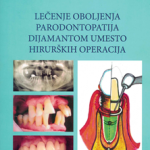 Lečenje oboljenja parodontopatija dijamantom umesto hirurških operacija
