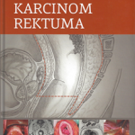 Z36149 Karcinom rektuma