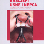 Rascjepi usne i nepca