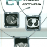 CT TORAKSA I ABDOMENA