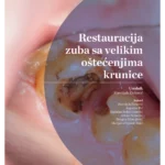 Restauracija zuba sa velikim oštećenjima krunice