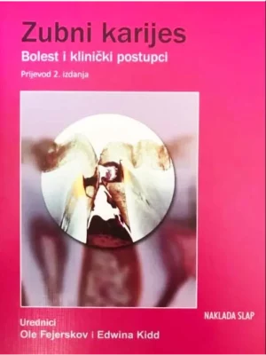 Zubni karijes-bolest i klinički postupci