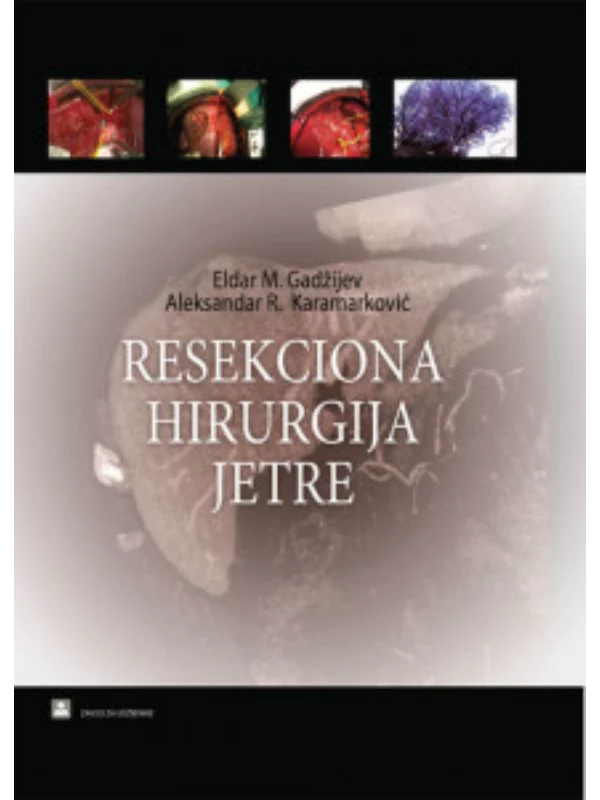 Resekciona hirurgija jetre 36146 - Image 1