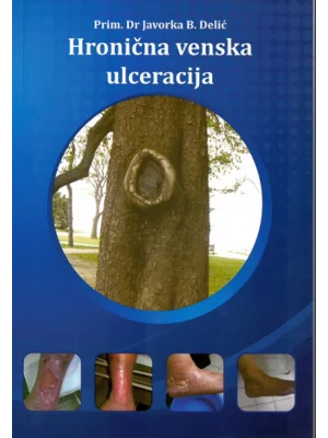 Hronicna venska ulceracija