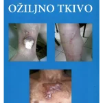 Ožiljno tkivo
