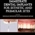 Immediate Dental Implants for Esthetic and Premolar Sites