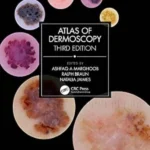 Atlas of Dermoscopy 3rd Edition